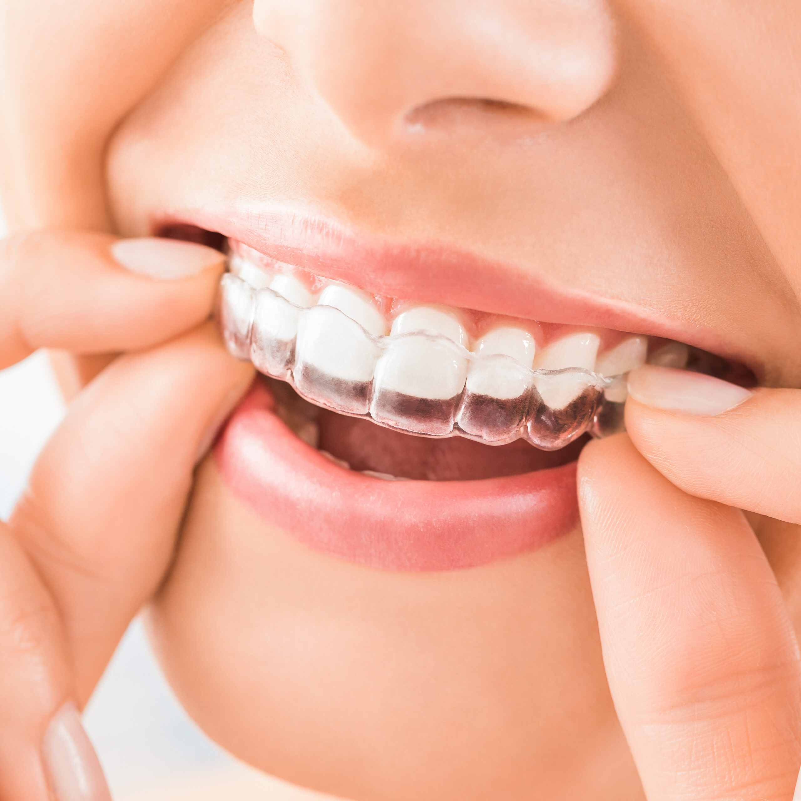 Invisalign_white